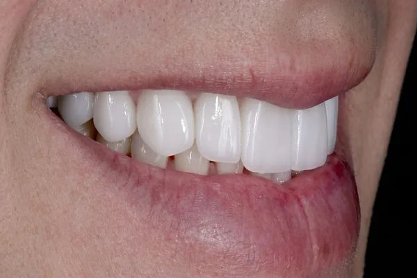 After cosmetic porcelain veneers