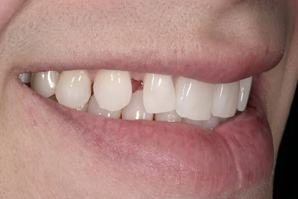 Before cosmetic porcelain veneers