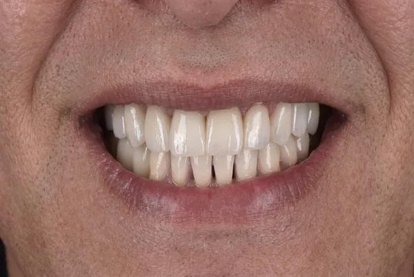 After dental implant surgery