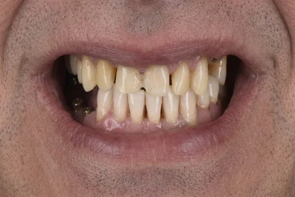 Before dental implant surgery