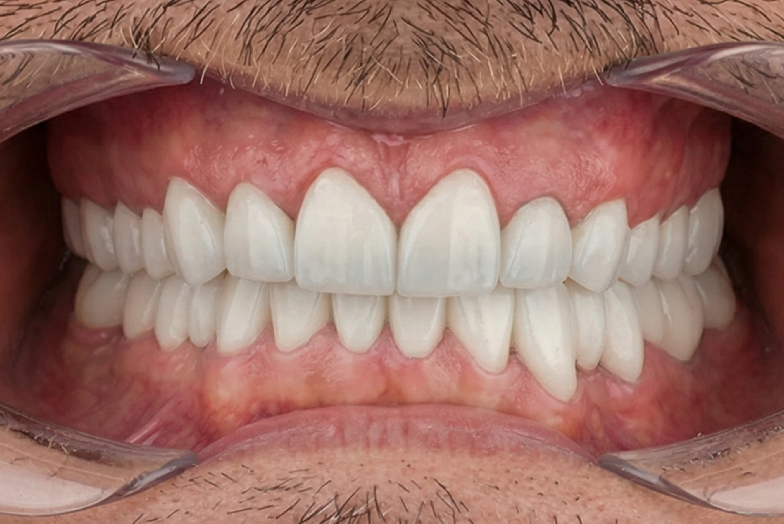 After jaw widening orthodontic treatment