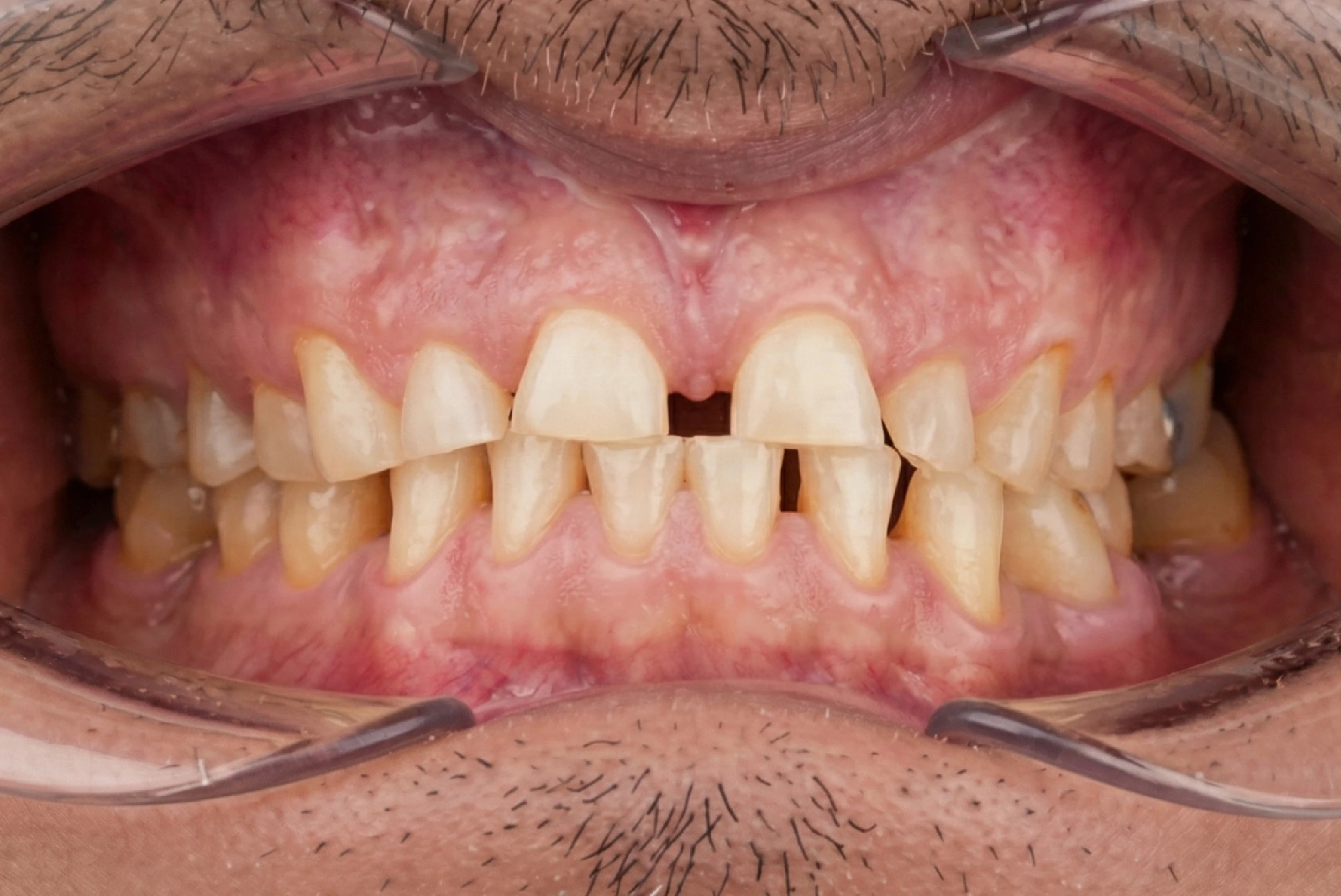 Before jaw widening orthodontic treatment