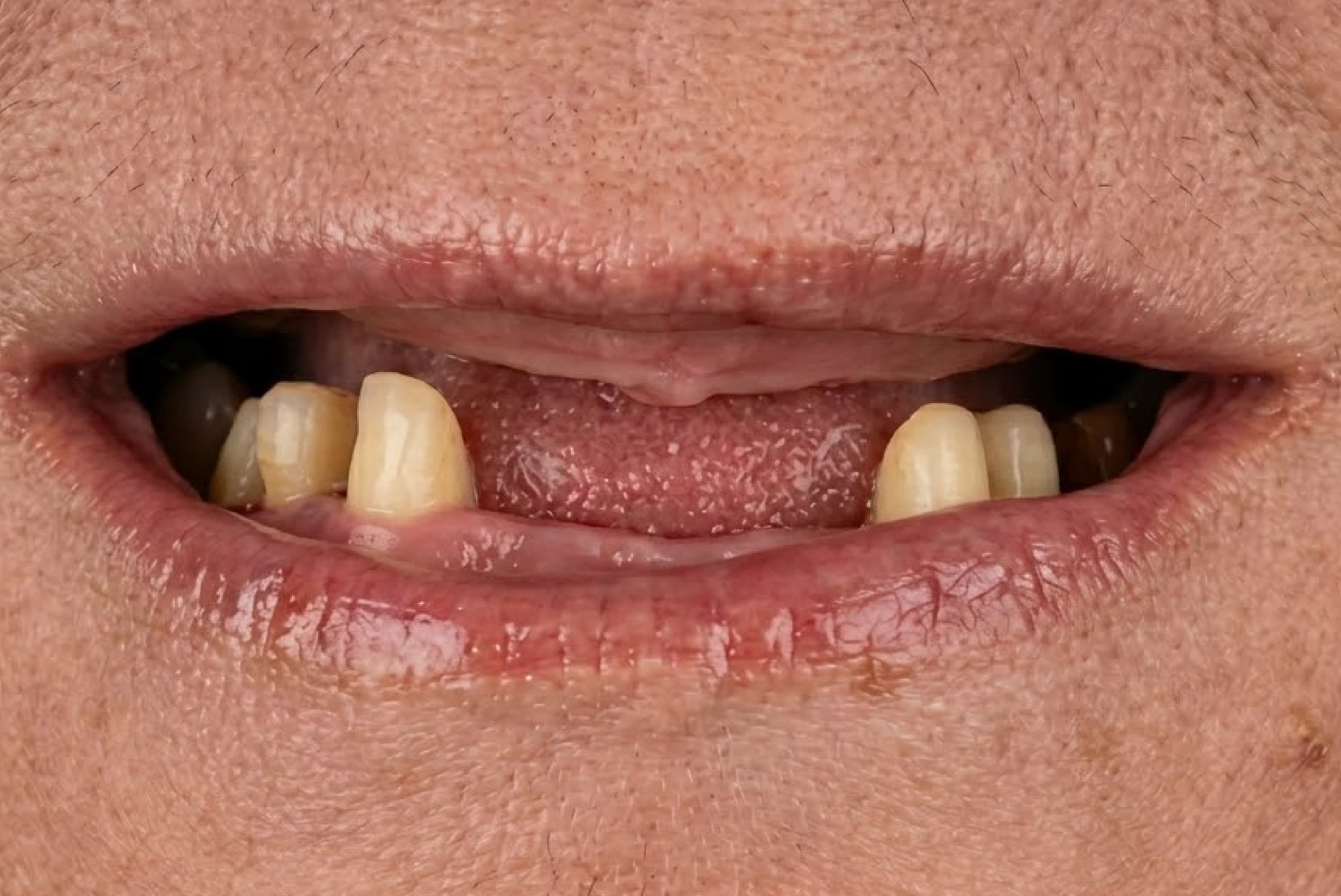 Before crowded teeth alignment